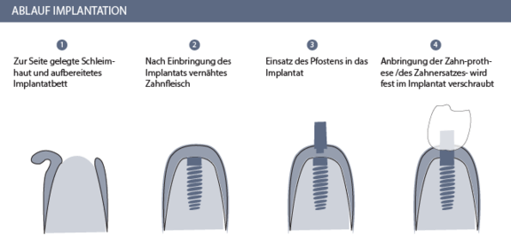 Ablauf Zahnimplantate, Zahnarzt für Zahnimplantate in Zürich